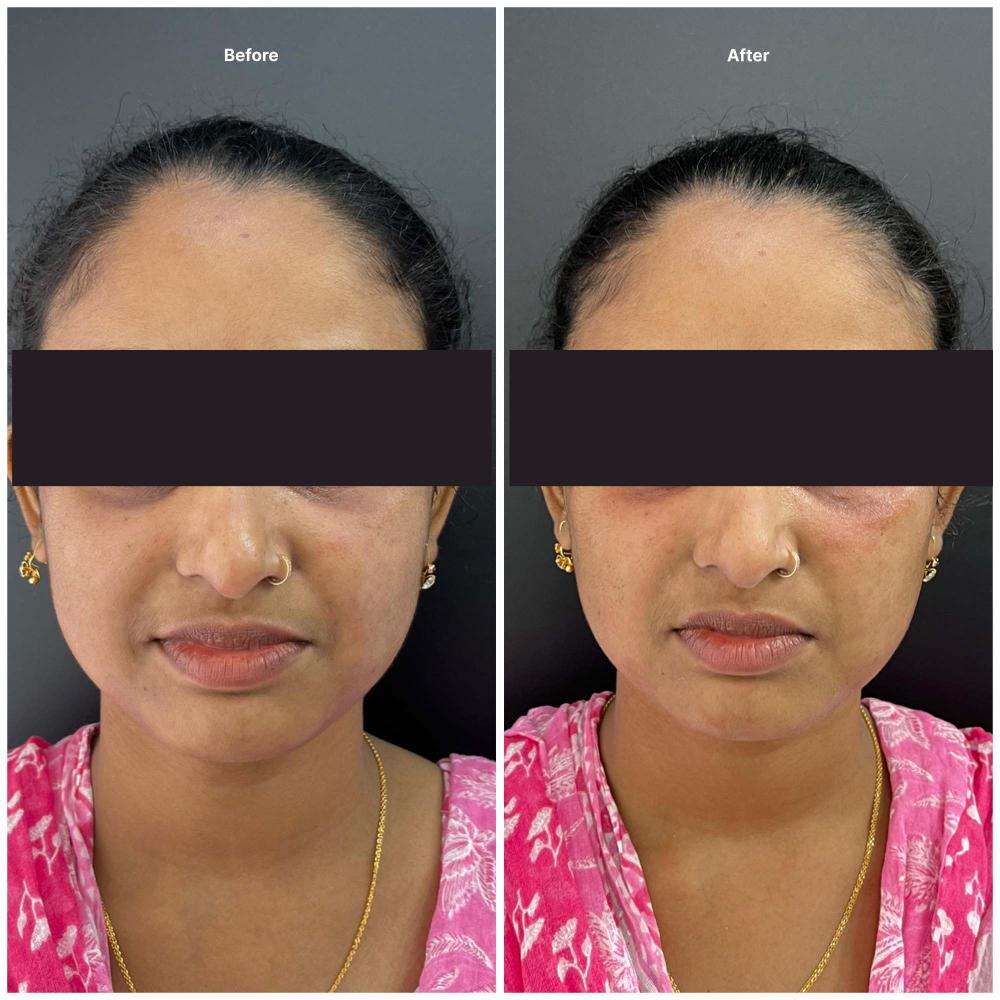 Botox result KOQ10
